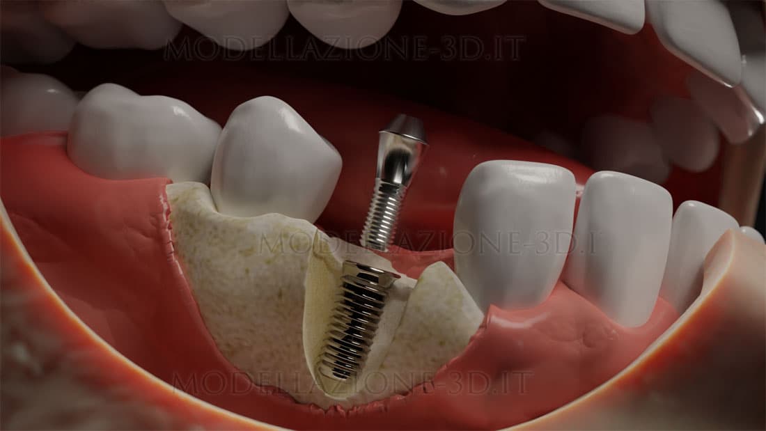 Impianto dentale installazione arcata inferiore